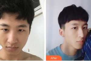 蚌埠美萊塢整形美容醫(yī)院姚然整形價格表附鼻部綜合案例展示