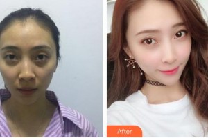 蚌埠美萊塢整形美容醫(yī)院潘志強整形價格表附自體脂肪填充案例展示