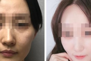 蚌埠立方醫(yī)療美容整形醫(yī)院王樹立整形價格表附埋線提升案例展示