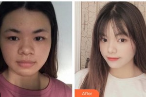 蚌埠立方醫(yī)療美容整形醫(yī)院徐靜整形價格表附埋線提升案例展示