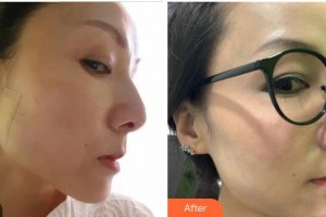 蚌埠華美整形美容門診部官赳駒整形價格表附埋線提升案例展示