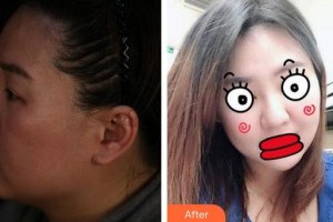 蚌埠華美整形美容門診部劉敏整形價格表附埋線提升案例展示