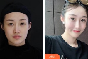 蚌埠韓美美萊醫(yī)療美容門診部鄭婕整形價格表附埋線提升案例展示