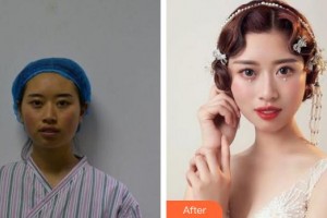 蚌埠韓美美萊醫(yī)療美容門診部張濤整形價格表附埋線提升案例展示