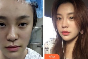 蚌埠韓美美萊醫(yī)療美容門診部張燕整形價格表附埋線提升案例展示