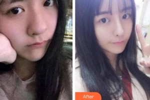 蚌埠韓美美萊醫(yī)療美容門診部周娜整形價格表附熱瑪吉案例展示