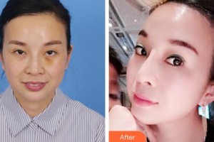 蚌埠韓美美萊醫(yī)療美容門診部歷芳整形價格表附埋線提升案例展示