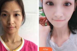 蚌埠市交通醫(yī)院醫(yī)療美容科劉永濤整形價格表附眼部綜合案例展示