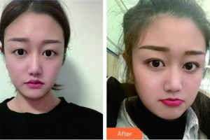 蚌埠市交通醫(yī)院醫(yī)療美容科湯學(xué)標(biāo)整形價格表附埋線雙眼皮案例展示