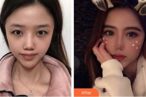 蚌埠康視眼科醫(yī)院葉金星整形價格表附眼部綜合案例展示