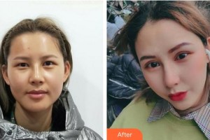 蚌埠康視眼科醫(yī)院高桂林整形價格表附眼部整形案例展示