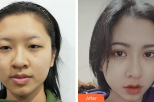 蚌埠康視眼科醫(yī)院汪蕾整形價格表附開內(nèi)眼角案例展示