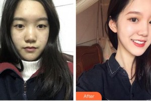 蚌埠康視眼科醫(yī)院王茜珂整形價格表附眼部綜合案例展示