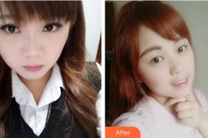 蚌埠三愛口腔門診部張迪整形價格表附牙齒隱形矯正案例展示