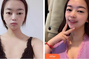 淮南凱婷美琪醫(yī)療美容醫(yī)院曹士華整形價格表附自體脂肪隆胸案例展示