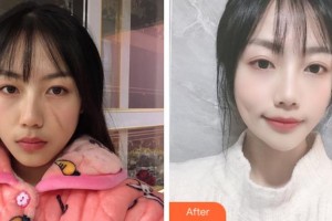 淮南市第一人民醫(yī)院燒傷整形科朱傳國整形價格表附微創(chuàng)疤痕修復案例展示