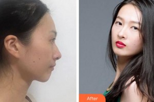 淮南凱婷美琪醫(yī)療美容醫(yī)院李立國整形價格表附鼻部綜合案例展示