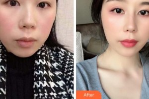 淮南麗顏醫(yī)療整形醫(yī)院陳愛寧整形價格表附鼻部綜合案例展示