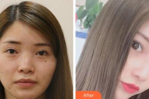 淮南美橙醫(yī)療整形美容醫(yī)院陳銘整形價格表附鼻部綜合案例展示