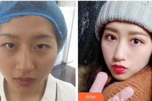 淮南華廈眼科醫(yī)院秦斌整形價格表附眼部綜合案例展示