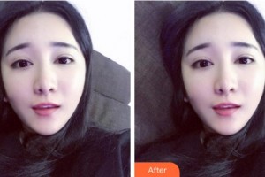 淮南華廈眼科醫(yī)院謝馳整形價格表附眼部整形案例展示