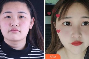 淮南澤明眼科醫(yī)院（原淮南東方醫(yī)院集團(tuán)眼科醫(yī)院）王丹梅整形價格表附眼部綜合案例展示