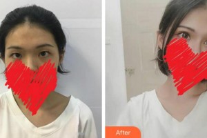 淮南澤明眼科醫(yī)院（原淮南東方醫(yī)院集團(tuán)眼科醫(yī)院）陳蓓莉整形價格表附切開雙眼皮】案例展示