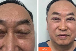 淮南澤明眼科醫(yī)院（原淮南東方醫(yī)院集團(tuán)眼科醫(yī)院）劉志剛整形價格表附切開雙眼皮案例展示