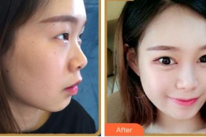 淮南澤明眼科醫(yī)院（原淮南東方醫(yī)院集團(tuán)眼科醫(yī)院）劉杰整形價格表附眼部綜合案例展示