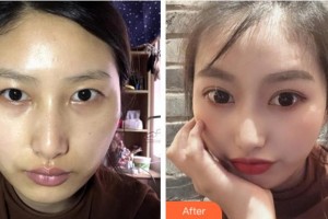 淮南澤明眼科醫(yī)院（原淮南東方醫(yī)院集團(tuán)眼科醫(yī)院）李福芝整形價格表附切開雙眼皮案例展示