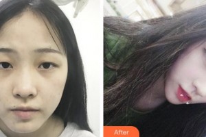 淮南晨光眼科醫(yī)院周本揚(yáng)整形價格表附切開雙眼皮案例展示