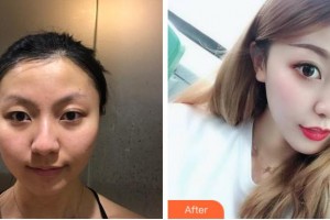 淮南晨光眼科醫(yī)院譚天住院醫(yī)師整形價格表附雙眼皮案例展示