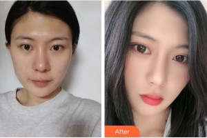 淮南華廈眼科醫(yī)院方玉蘭整形價格表附眼部綜合案例展示