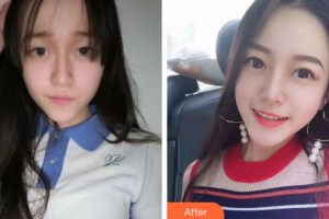 淮南新華醫(yī)院眼科江軍整形價格表附切開雙眼皮案例展示