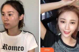 淮南東方醫(yī)院集團(tuán)總醫(yī)院燒傷整形科蔣新安整形價格表附點陣激光案例展示