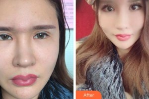 淮南鳳凰醫(yī)院眼科宮斌整形價格表附眼部修復(fù)案例展示