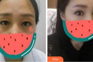 馬鞍山人民醫(yī)院醫(yī)學(xué)美容科石京頤整形價格表附切開雙眼皮案例展示