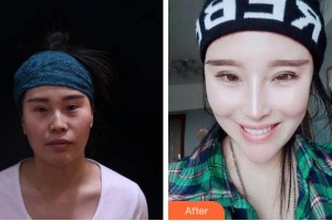 馬鞍山福華醫(yī)療美容醫(yī)院呂福華整形價格表附耳軟骨復(fù)合隆鼻案例展示