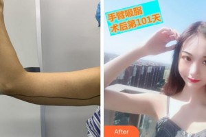 馬鞍山福華醫(yī)療美容醫(yī)院李建云整形價(jià)格表附美體塑形案例展示