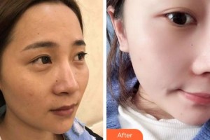 馬鞍山福華醫(yī)療美容醫(yī)院李剛整形價(jià)格表附鼻部綜合案例展示