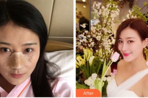 馬鞍山御星醫(yī)療美容醫(yī)院陳浩整形價(jià)格表附鼻部綜合案例展示