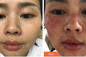 馬鞍山柯匯醫(yī)療美容醫(yī)院張志強(qiáng)整形價(jià)格表附激光美膚激光案例展示