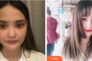 馬鞍山御星醫(yī)療美容醫(yī)院張少翔整形價(jià)格表附耳軟骨復(fù)合隆鼻案例展示