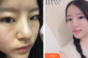 馬鞍山愛(ài)爾眼科醫(yī)院徐六三整形價(jià)格表附切開(kāi)雙眼皮案例展示