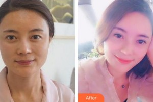 馬鞍山愛(ài)爾眼科醫(yī)院江潔整形價(jià)格表附切開(kāi)雙眼皮案例展示