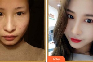 馬鞍山愛(ài)爾眼科醫(yī)院周慧婷住院醫(yī)師整形價(jià)格表附眼部綜合案例展示