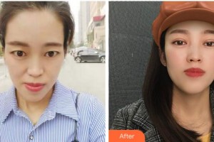 馬鞍山康視眼科醫(yī)院李華整形價(jià)格表附切開(kāi)雙眼皮案例展示