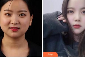 馬鞍山康視眼科醫(yī)院王子南整形價(jià)格表附眼部綜合案例展示