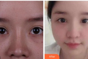 馬鞍山康視眼科醫(yī)院王林農(nóng)整形價(jià)格表附切開(kāi)雙眼皮案例展示