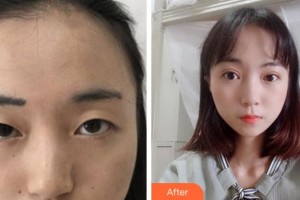 馬鞍山康視眼科醫(yī)院王育良整形價(jià)格表附切開(kāi)雙眼皮案例展示